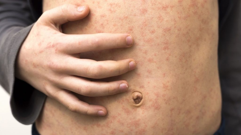 CDC warns of progress against threatened measles during the COVID-19 pandemic
